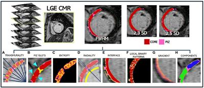 Machine learning analysis of complex late gadolinium enhancement patterns to improve risk prediction of major arrhythmic events